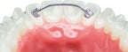 Lingual Retainers| IOS