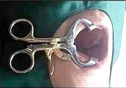 Molt Mouth Gag ( mouth opener | EXLIN
