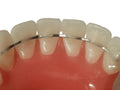 Lingual Retainer