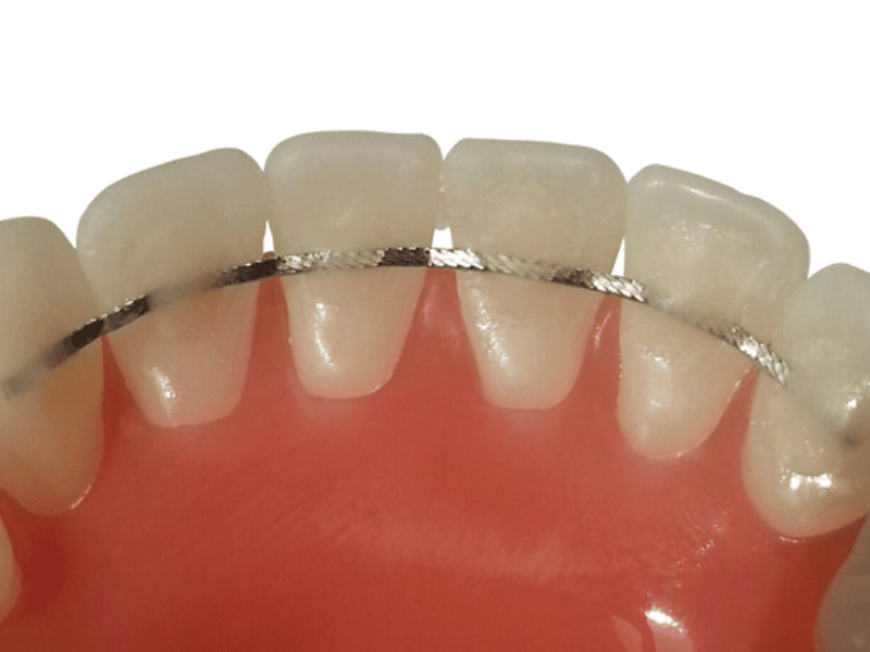 Lingual Retainer