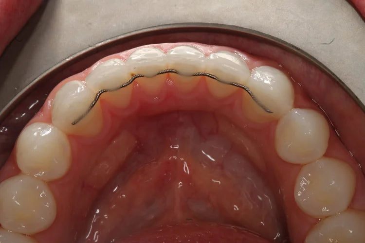 Fixed Retainer Wire