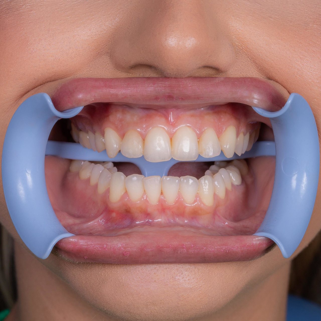 Lip expandex  | INDUSBELLO