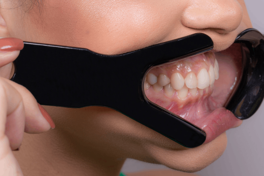 V-shaped Lip Retractor  | INDUSBELLO