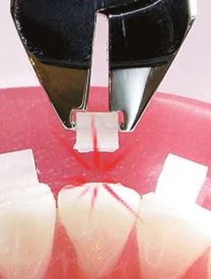 Ceramic Bracket Debonding plier| IOS
