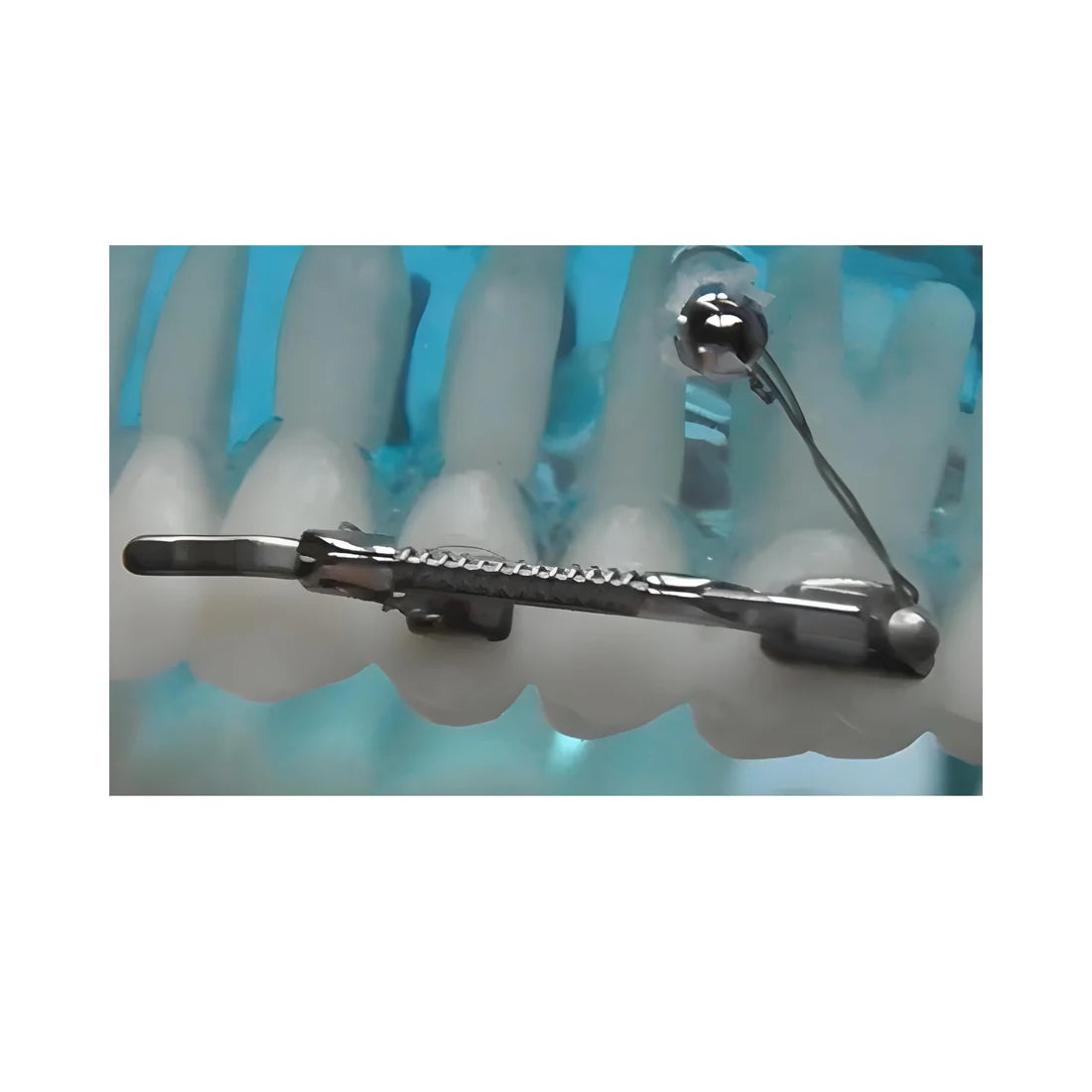 Molar Distalizer| summit