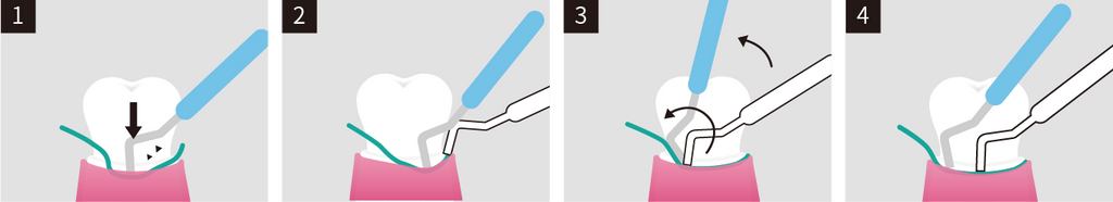 SURE-CORD®PLUS | SUREDENT