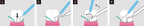 SURE-CORD®PLUS | SUREDENT