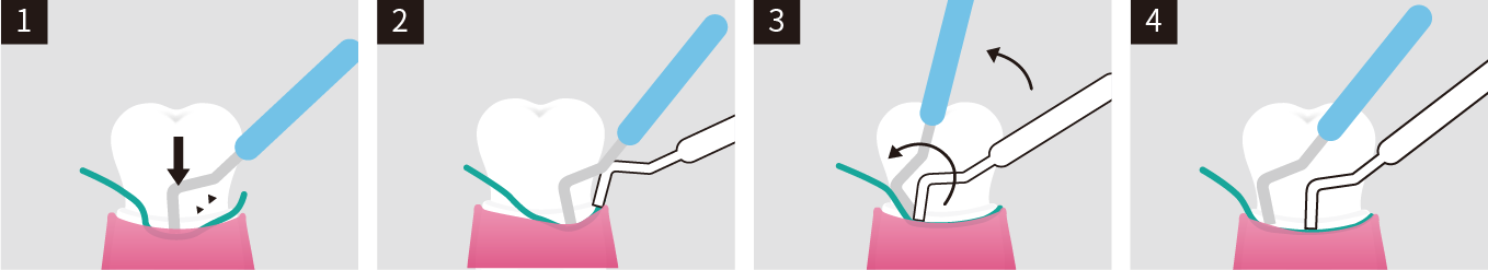 SURE-CORD®PLUS | SUREDENT